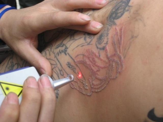 The Liberty Tattoo Removal Program under the auspices of the Economic 
