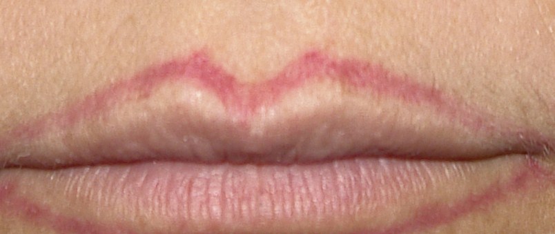 Cutaneous T Cell Pseudolymphoma at the Site of a Semipermanent LipLiner  Tattoo  Semantic Scholar